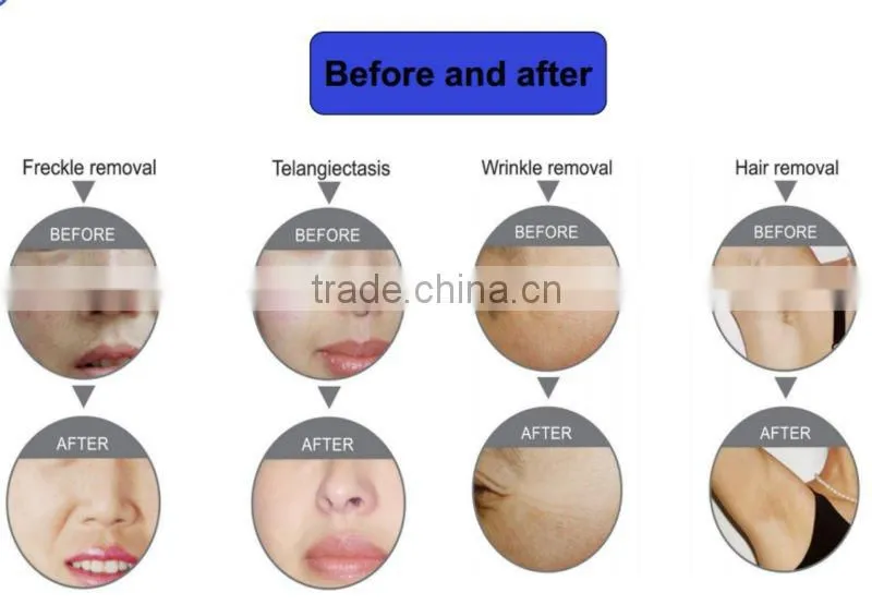 2013 new arrival IPL+RF hair Removal equipment