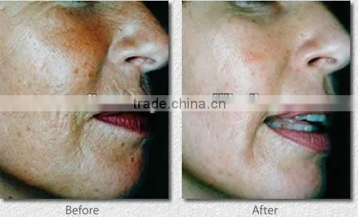 Factory direct sale skin rejuvenation 540 needles derma roller