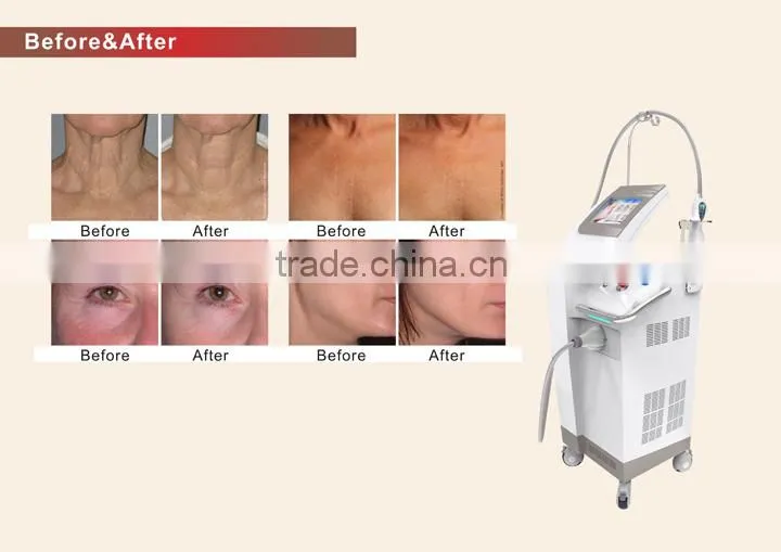 Fractional RF Facial Treatment Machine
