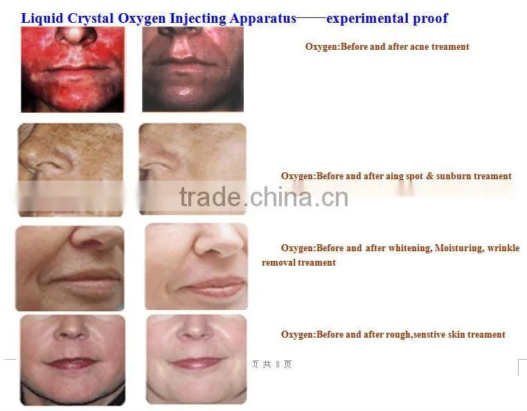 oxygen facial machine