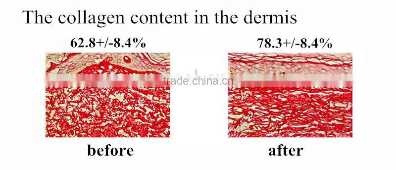 2015 Hot Sale Portable Photon Therapy LED PDT Machine /pdt led light skin beauty machine