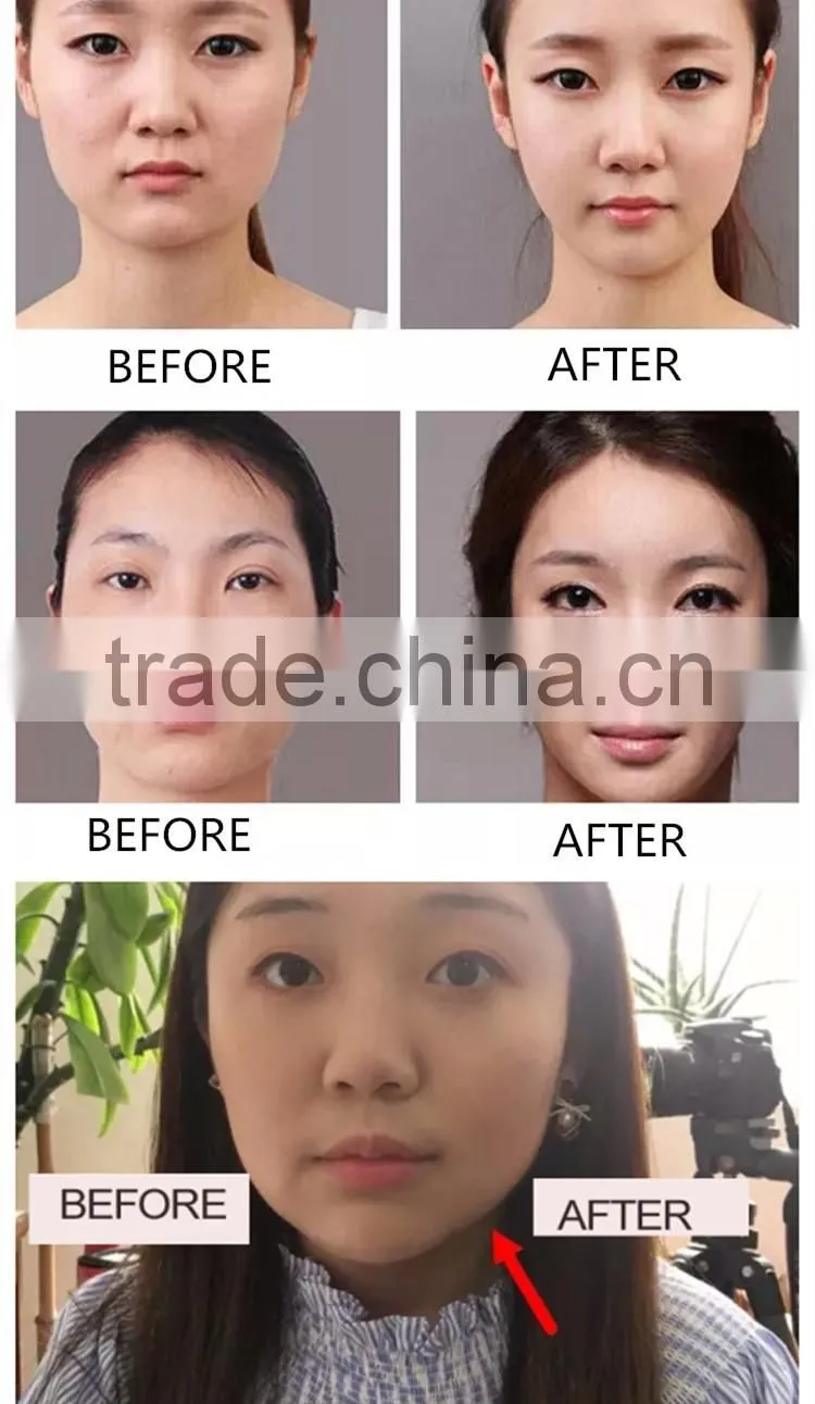 Compression Face lifting Skin rejuvernation types of radio frequency