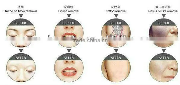 mini 532nm 1064nm home laser skin tightening machine pigment for permanent makeup