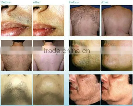 2016 best sales beauty device long pulse nd yag laser hair removal
