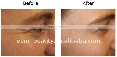 Mobile salon equipment Hair epilator ipl quantum laser A005