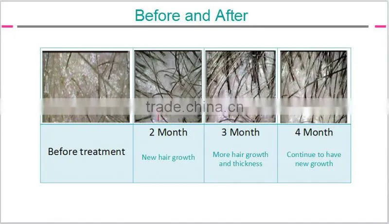 ce approval diode laser hair regrowth machine/laser cap for hair regrowth