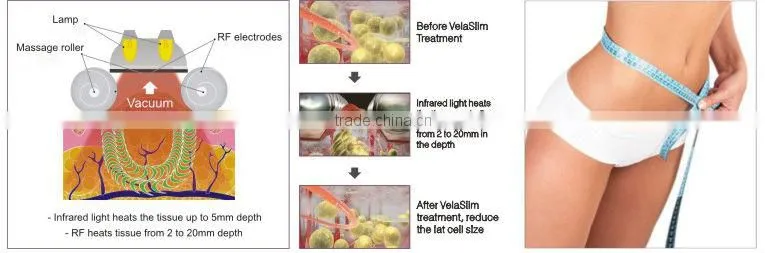 Freezing Fat Away Weight Loss Ice Sculpt Cryolipolyse