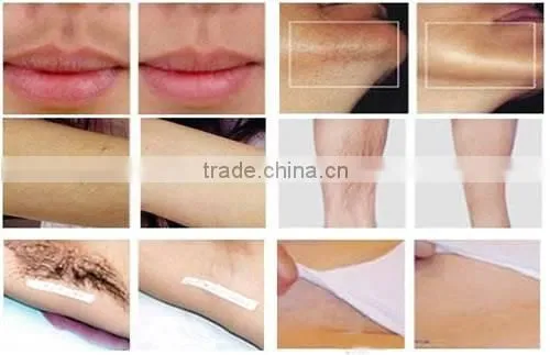 Hottest newest double pulse 808 diode laser portable