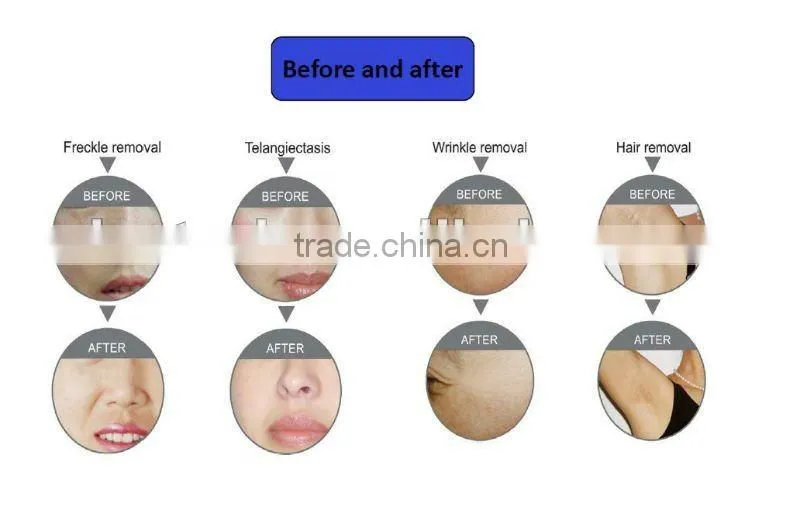 Promotion!! Painless Wrinkl Removal IPL+RF Beauty Machine