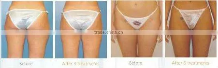2012 CAVITATION VAC for Body Shaping & CE