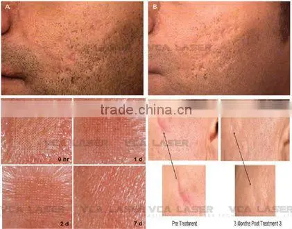 Removal Scar CO2 fractional laser beauty equipment