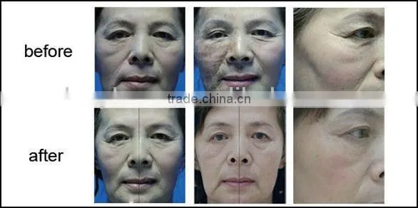 10600nm laser equipment co2 fractional