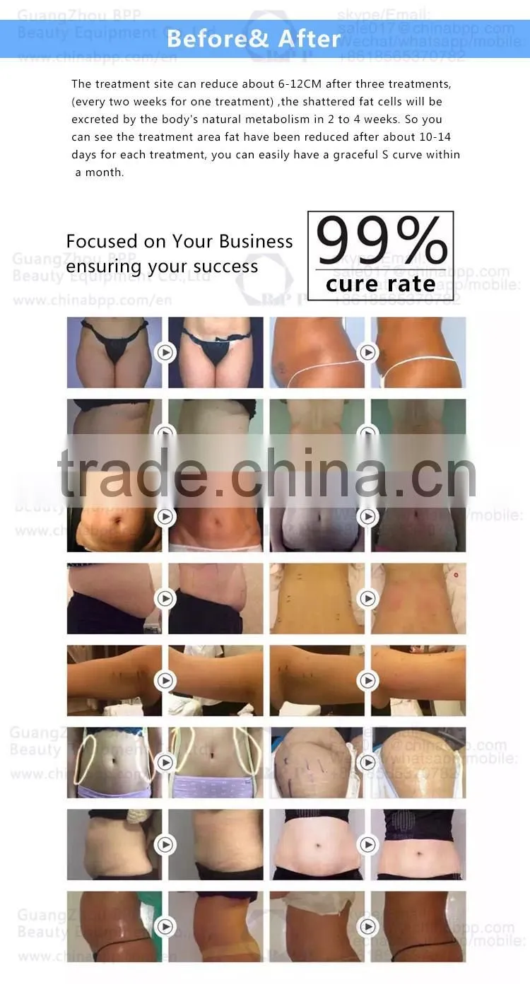HIFU ultrashape best new slimming technology machine