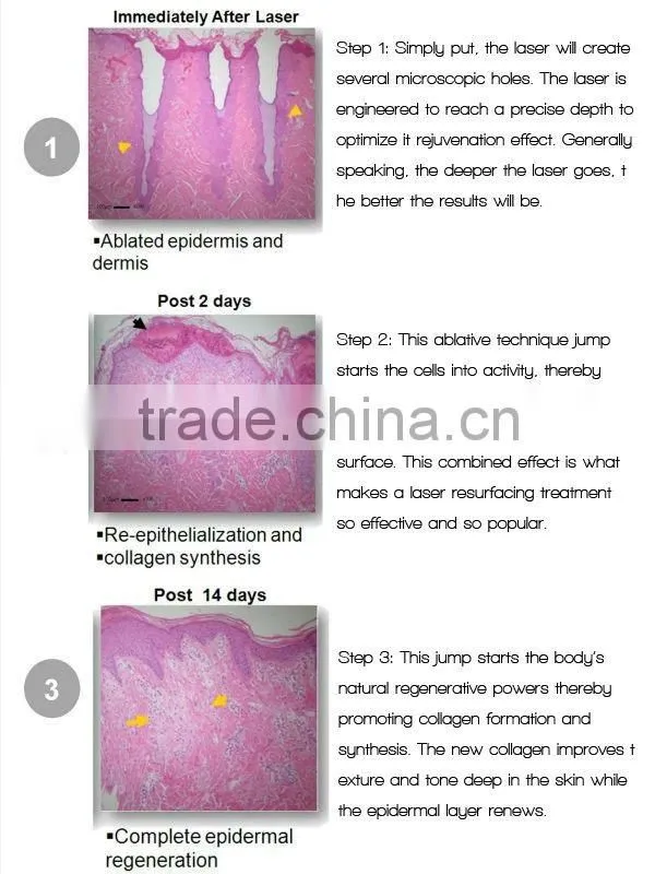 CO2 medical Laser equipment CO2 fractional laser resurfacing system