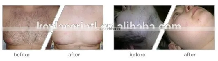 latest beauty equipmentipl shr laser hair removal machines shr ipl hair removal for sale with two handles