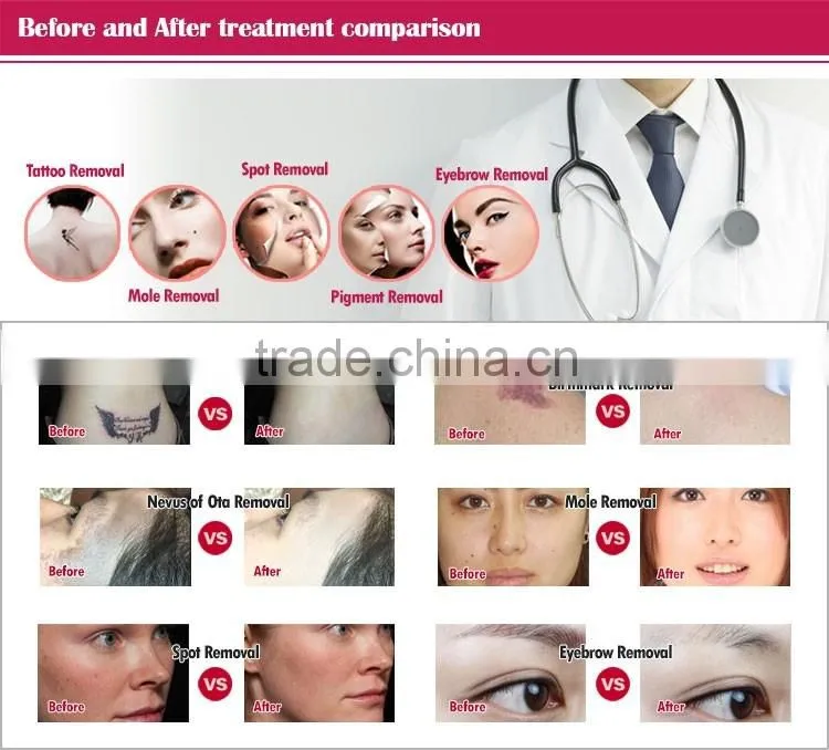 High quality professional tattoo removal q-switch laser