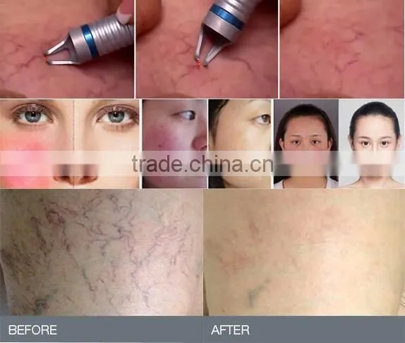 980nm diode laser vascular removal machine