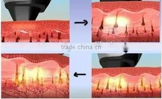 factory price portable 808nm depilation laser for home hair removal machine