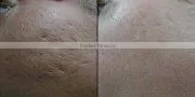 Newest !!! luxury fractional co2 laser acne scar removal