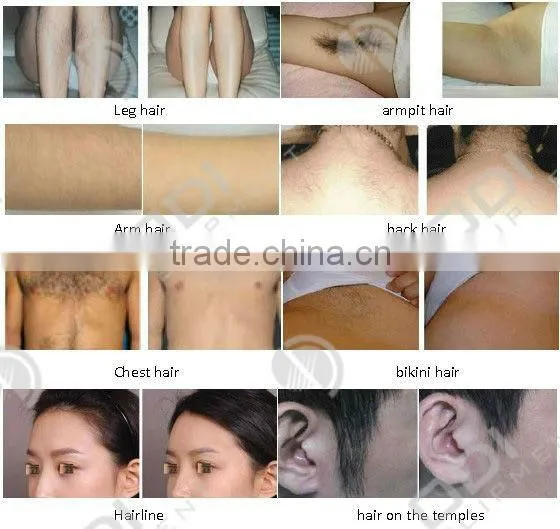LS808 808nm 5w Laser Diode/808nm Diode Laser For Permanent Hair Removal with CE