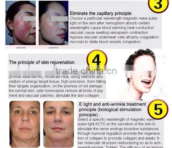 Skin Whitening Treatment/Laser Hair Removal SHR IPL Machine Laser Treatment For Skin Whitening