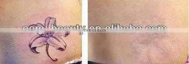 Newest laser tattoo removal machine permanent and pain free tattoo removal