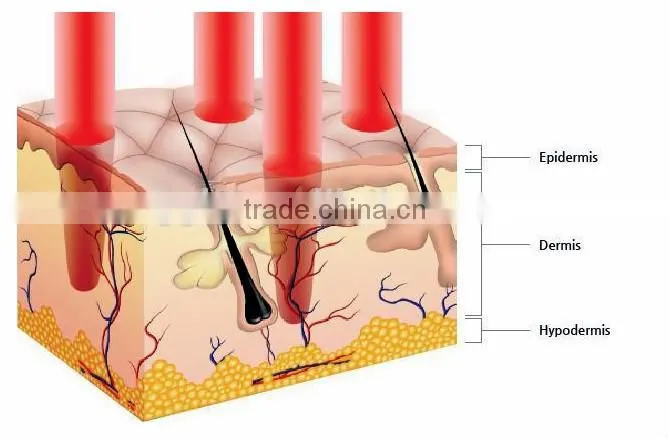 ipl+rf shr nd yag laser hair removal skin care multi-functional machine