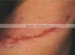 CO2 fractional laser machine for wrinkle removal