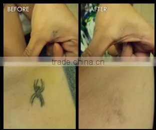 Laser Type and Yes Q-Switch laser tattoo remover price for clinic beauty equipment