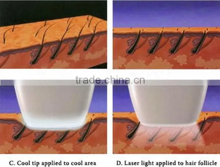 CE Approved HIgh Power Vertical Diode Laser Beauty Equipment For Hair Removal