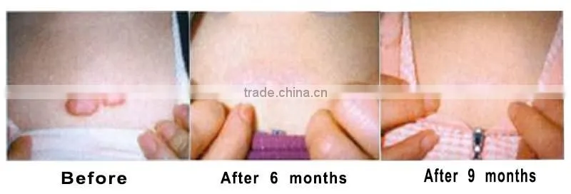 Popular Style!! Skin Rejuvenation Laser Vaginal Tightening Device CO2 Laser Fractional Machine with CE