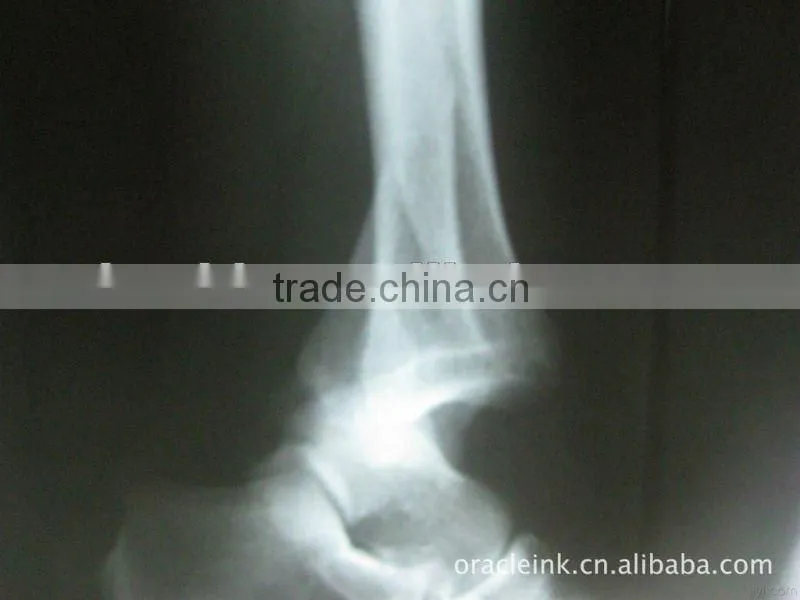 Medical film from manufacturer,x ray film,dry imaging film printed with fuji and agfa printers