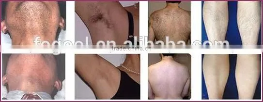 types of laser hair removal machine/laser hair removal turkey/laser hair removal cost