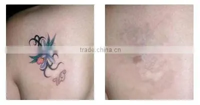 Portable Laser Tattoo Removal Kits