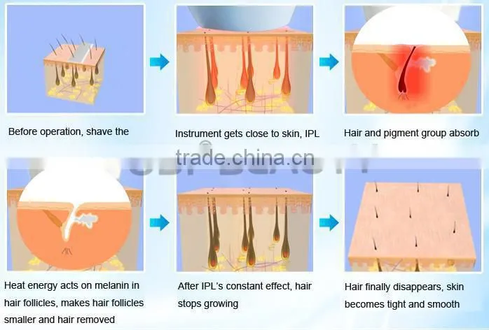 Top selling acne treatment and face lift feature hair removal ipl portable