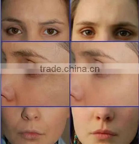 2014 new products Portable rf skin tightening face lifting home use high frequency ultrasonic galvanic facial beauty machine