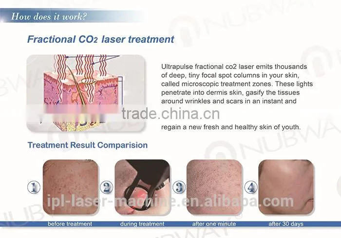 2015 Lowest Distributor price: laser co2 fraccionado for Acne Scars Treatment , Burn Debridement