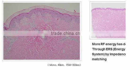 Personal care and beauty series product fractional rf skin lifting machine