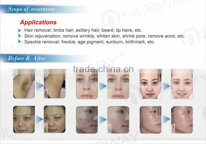 SHR IPL Elight Acne Scar Removal Machine/ Home Permanent Hair Removal
