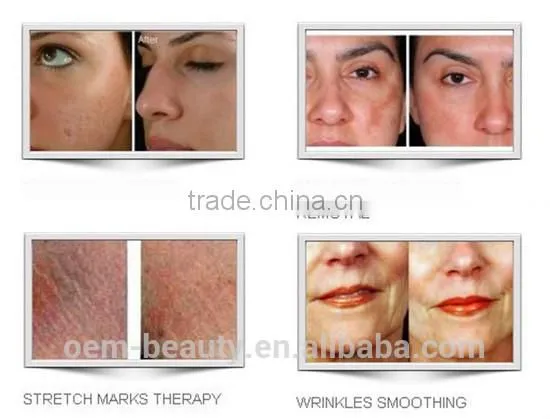 Yyr high quality newest comprehensive device zgts drs derma roller system factory direct wholesale