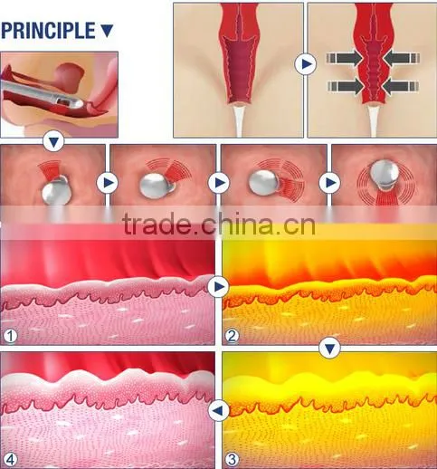 Co2 fractional laser vagonal tightening/scar removal beauty equipment