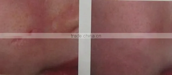 # portable fractional co2 laser equipment for acne scar removal