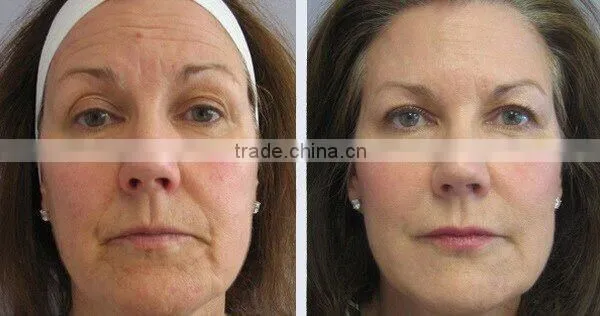 UK xenon lamp two hand-pieces IPL SHR E-light plus RF radio frequency facial machine