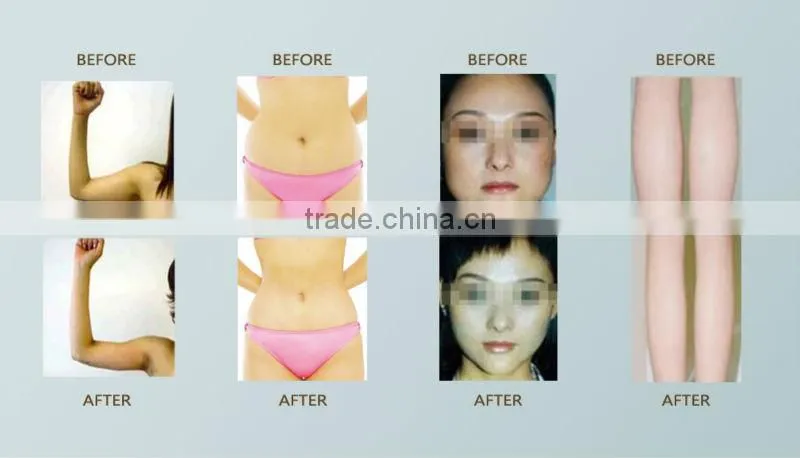Portable Cryolipolysis Slimming Machine SL-2 for Home Use