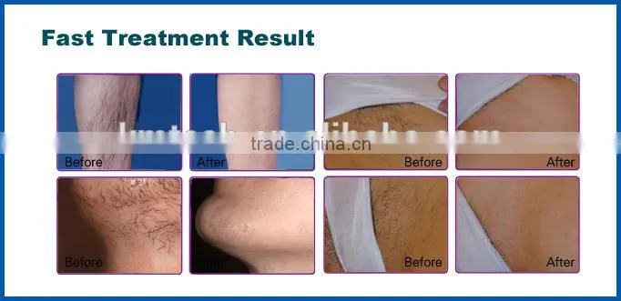 Hot selling permanent laser diode hair removal