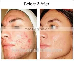 Microneedle Roller Skin Care System for All Skin Types
