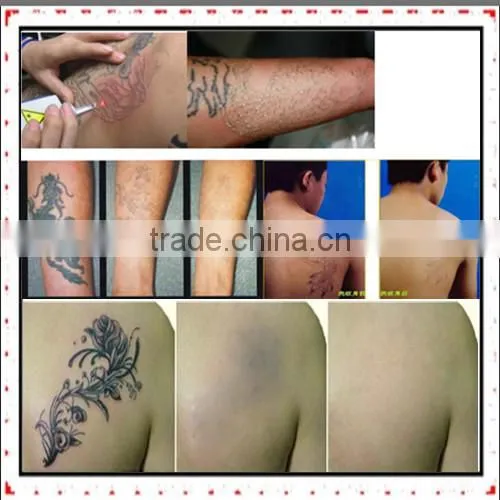 Alibaba china suppliers hot-sale RGB Double Rod tattoo laser removal machine