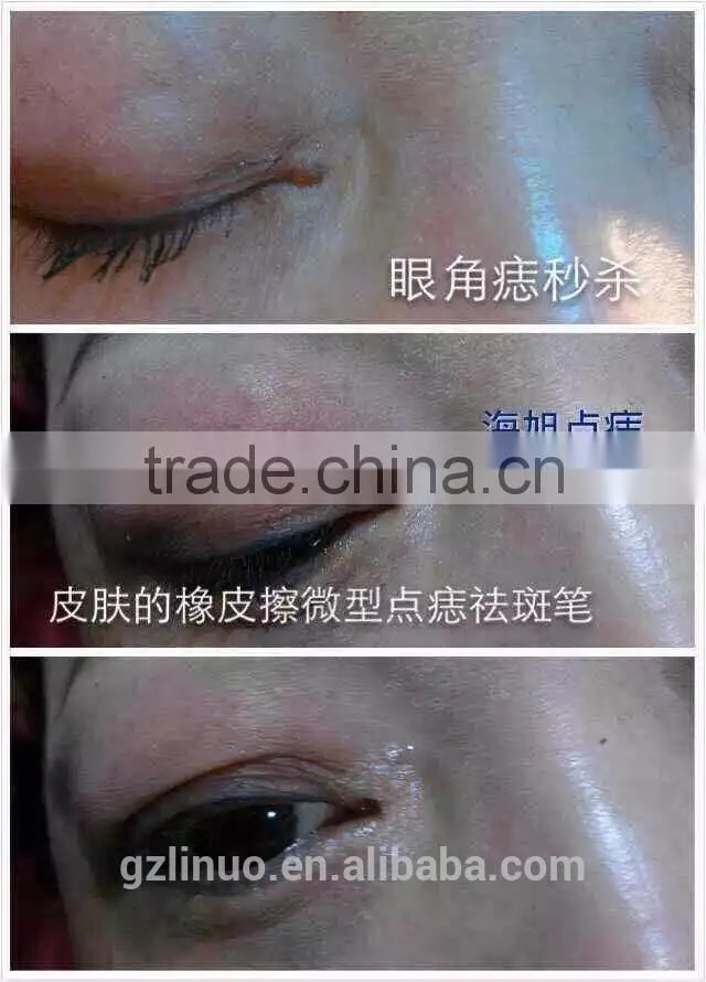 hand-held spot removal machine,high frequency current spot removal