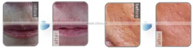 Top quality! CE/FDA approved rf fractional equipment