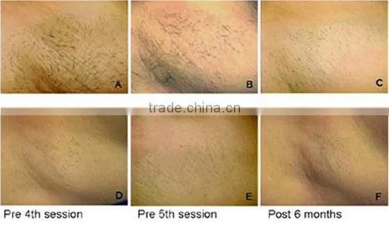 2015 newest Italy portable 808nm Diode Laser Hair Removal beauty equipment&machine